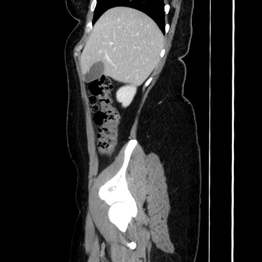 Acute uncomplicated appendicitis (Radiopaedia 73704-84499 Sagittal C+ portal venous phase 67).jpg