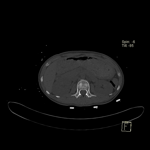 File:Acute vertebral compression fracture (Radiopaedia 63832-72559 Axial bone window 13).jpg