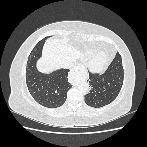 Adenocarcinoma in situ of lung (Radiopaedia 38685-40829 B 173).png