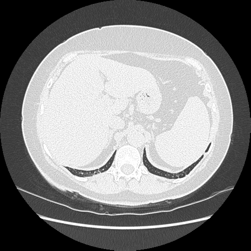Adenocarcinoma in situ of lung (Radiopaedia 38685-40829 B 210).png