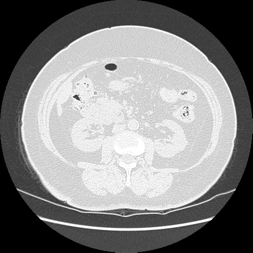 Adenocarcinoma in situ of lung (Radiopaedia 38685-40829 B 269).png