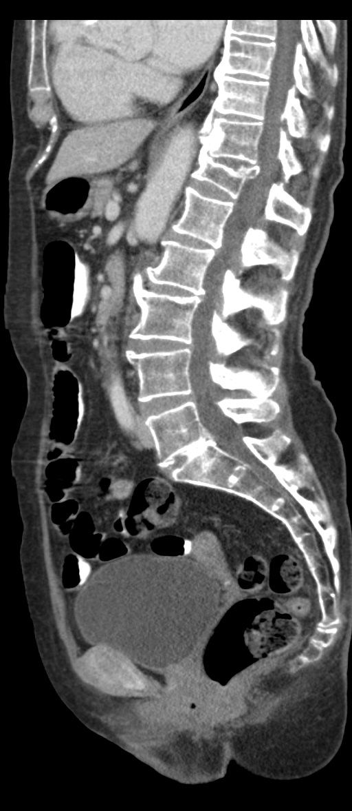 Adenocarcinoma of cecum (Radiopaedia 59222-66549 Sagittal C+ portal venous phase 44).jpg