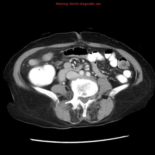 Adenocarcinoma of the colon (Radiopaedia 8191-9039 Axial liver window 45).jpg