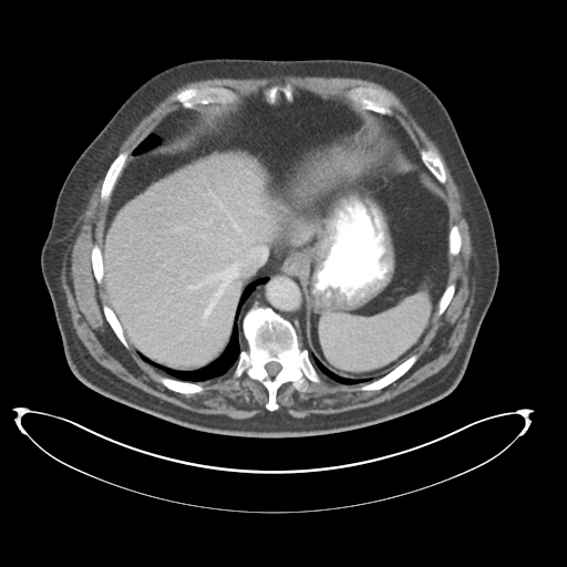 Adenocarcioma of rectum- T1 lesion (Radiopaedia 36921-38547 Axial C+ portal venous phase 15).png