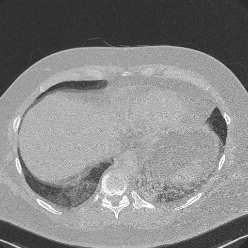 File:Adenoid cystic carcinoma of the trachea (Radiopaedia 49042-54137 Axial lung window 278).jpg