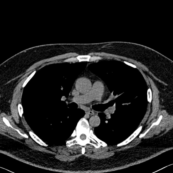 Adenoid cystic carcinoma of the trachea (Radiopaedia 49042-54137 Axial non-contrast 151).jpg