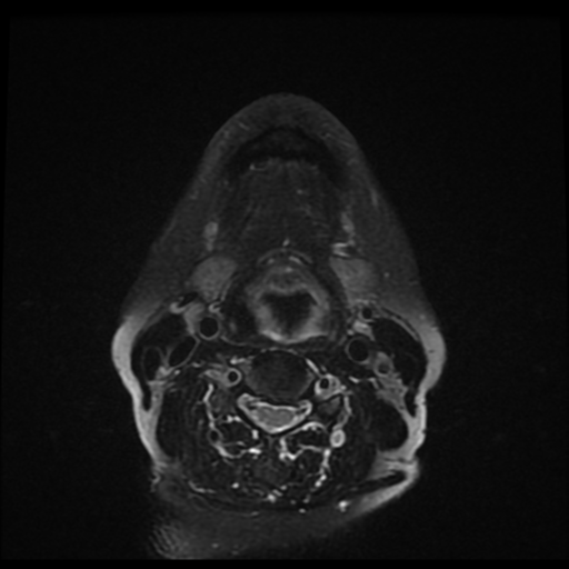 File:Adenoid cystic tumor of palate (Radiopaedia 46980-51519 Axial T2 fat sat 9).png