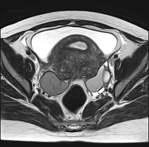 File:Adenomyosis - ovarian endometriomas (Radiopaedia 67031-76350 Axial T2 14).jpg