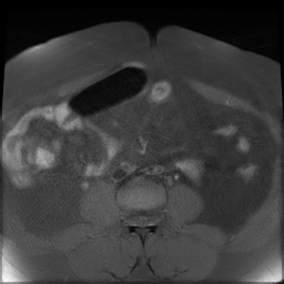 File:Adenomyosis within a didelphys uterus (Radiopaedia 70175-80215 Axial T1 fat sat 6).jpg