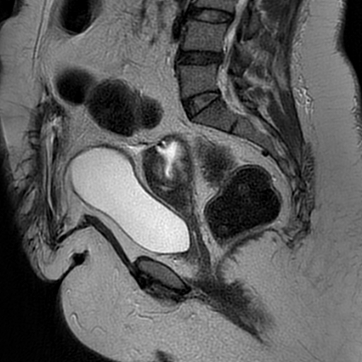 File:Adenomyosis within a didelphys uterus (Radiopaedia 70175-80215 Sagittal T2 21).jpg