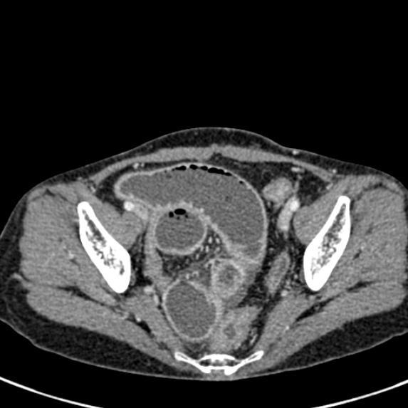 Adhesional small bowel obstruction (Radiopaedia 48397-53305 Axial C+ portal venous phase 78).jpg