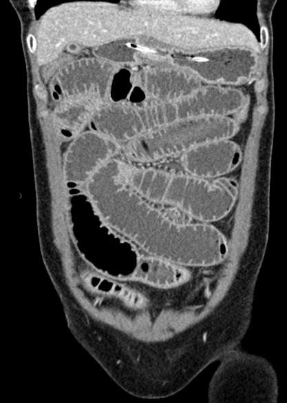 Adhesional small bowel obstruction (Radiopaedia 48397-53305 Coronal C+ portal venous phase 92).jpg