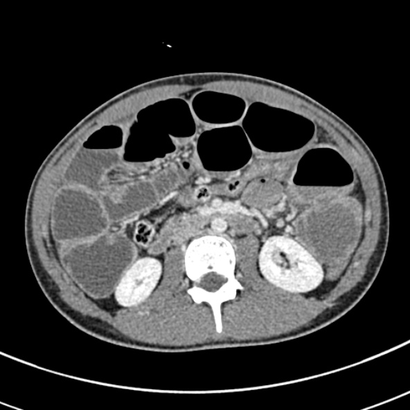 Adhesional small bowel obstruction (Radiopaedia 52107-57980 Axial C+ portal venous phase 52).jpg