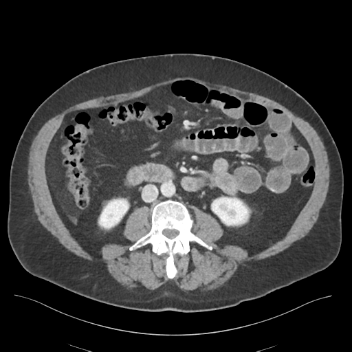 File:Adhesions within abdominal wall hernia (Radiopaedia 58283-65394 Axial C+ portal venous phase 43).png