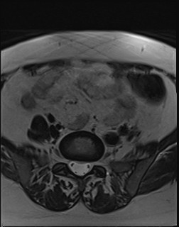 File:Adnexal multilocular cyst (O-RADS US 3- O-RADS MRI 3) (Radiopaedia 87426-103754 Axial T2 1).jpg