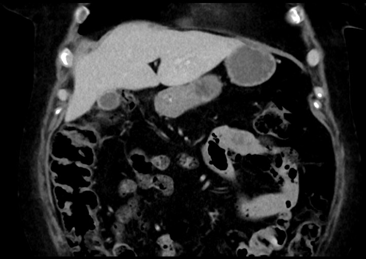 Adrenal cortical carcinoma (Radiopaedia 64017-72769 Coronal C+ portal venous phase 15).jpg