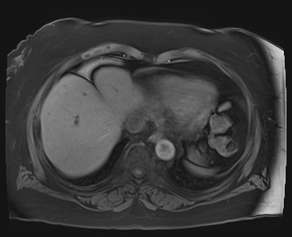 Adrenal cortical carcinoma (Radiopaedia 64017-72770 Axial T1 fat sat 2).jpg