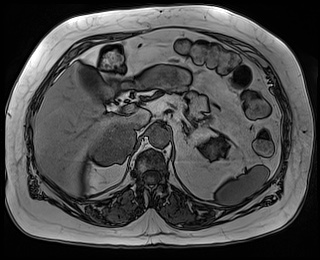 File:Adrenal cortical carcinoma (Radiopaedia 64017-72770 Axial T1 out-of-phase 24).jpg