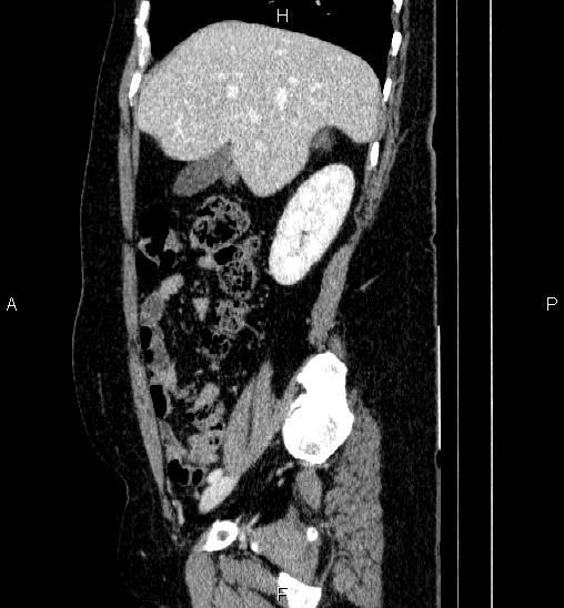File:Adrenal cortical carcinoma (Radiopaedia 84882-100379 Sagittal C+ portal venous phase 26).jpg