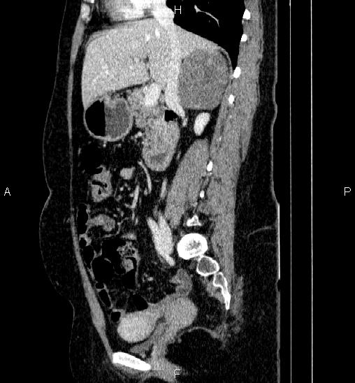 Adrenal cortical carcinoma (Radiopaedia 84882-100379 Sagittal C+ portal venous phase 38).jpg