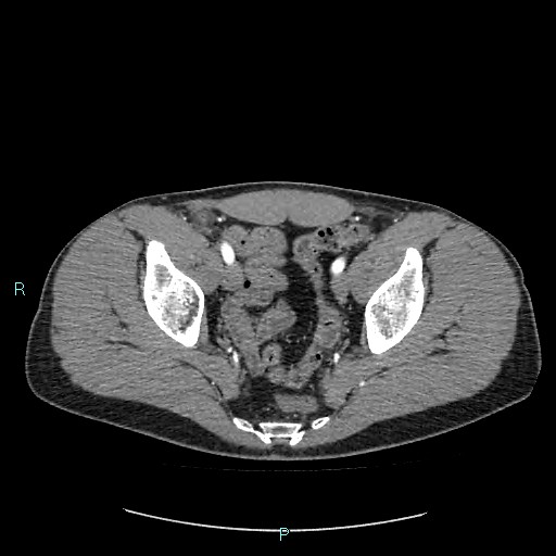 Adrenal cystic lymphangioma (Radiopaedia 83161-97534 Axial C+ arterial phase 86).jpg