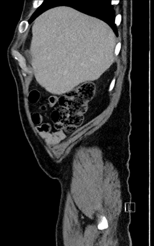 Adrenal lymphoma (Radiopaedia 73730-84529 Sagittal C+ portal venous phase 14).jpg
