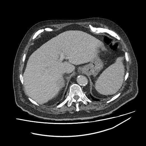 Adrenal lymphoma (Radiopaedia 84145-99415 Axial C+ portal venous phase 12).jpg