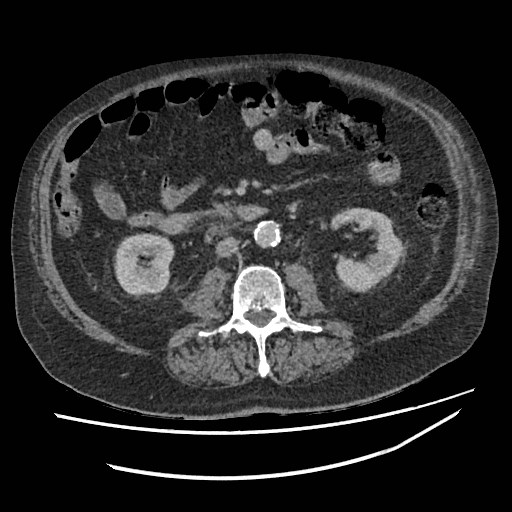 Adrenal lymphoma (Radiopaedia 84145-99415 Axial C+ portal venous phase 69).jpg