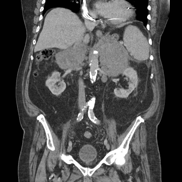 Adrenal lymphoma (Radiopaedia 84145-99415 Coronal C+ portal venous phase 46).jpg