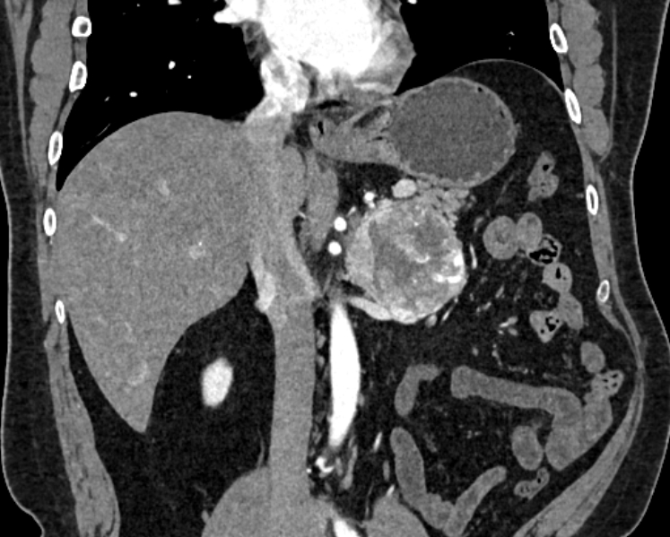 Adrenal metastases (Radiopaedia 73082-83791 Coronal C+ arterial phase 22).jpg