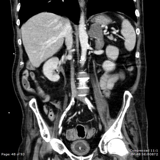 Adrenal metastasis (Radiopaedia 78425-91079 Sagittal C+ portal venous phase 35).jpg