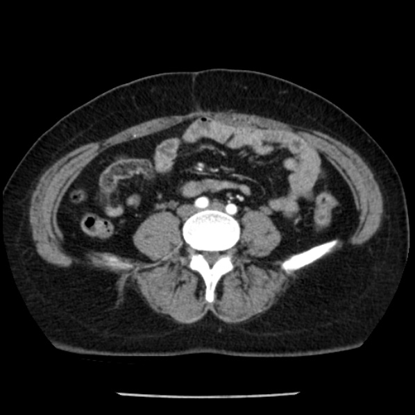 Adrenal myelolipoma (Radiopaedia 43401-46759 Axial C+ arterial phase 66).jpg