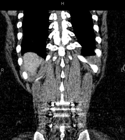 Adrenal myelolipoma (Radiopaedia 84319-99617 Coronal renal cortical phase 69).jpg