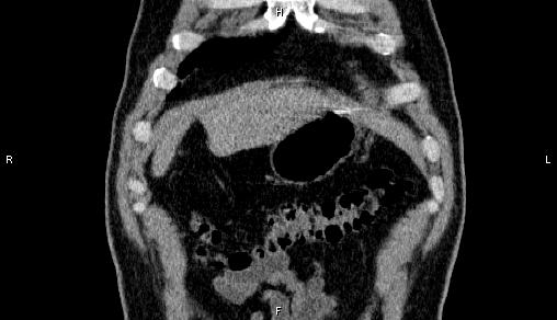 Adrenal myelolipoma (Radiopaedia 84321-99619 Coronal non-contrast 7).jpg