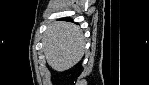 Adrenal myelolipoma (Radiopaedia 84321-99619 Sagittal non-contrast 11).jpg