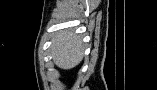 Adrenal myelolipoma (Radiopaedia 84321-99619 Sagittal non-contrast 8).jpg