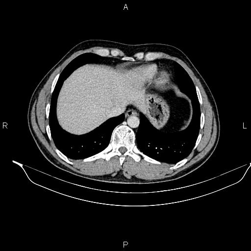 Adrenal myelolipoma (Radiopaedia 87794-104246 Axial renal cortical phase 14).jpg