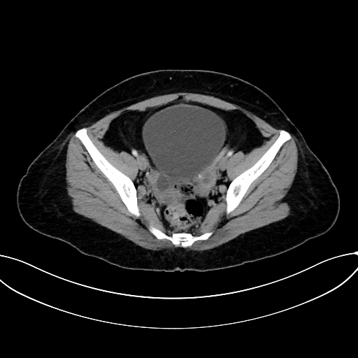 File:Adrenocortical carcinoma (Radiopaedia 87281-103569 Axial C+ portal venous phase 72).jpg