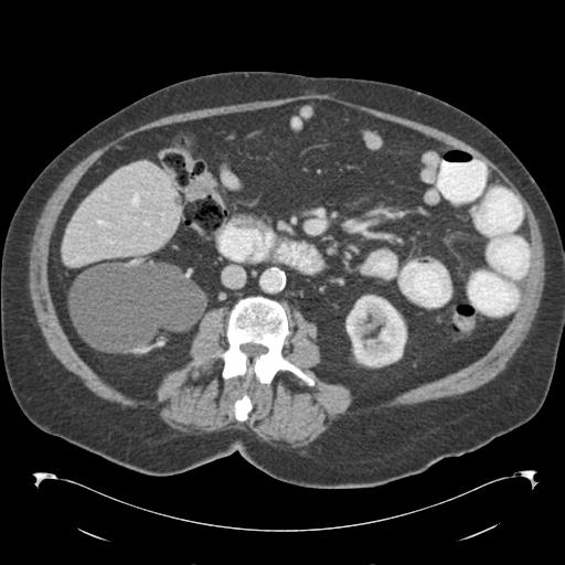 Adult ileal intussusception with secondary obstruction (Radiopaedia 30395-31051 Axial C+ portal venous phase 37).jpg
