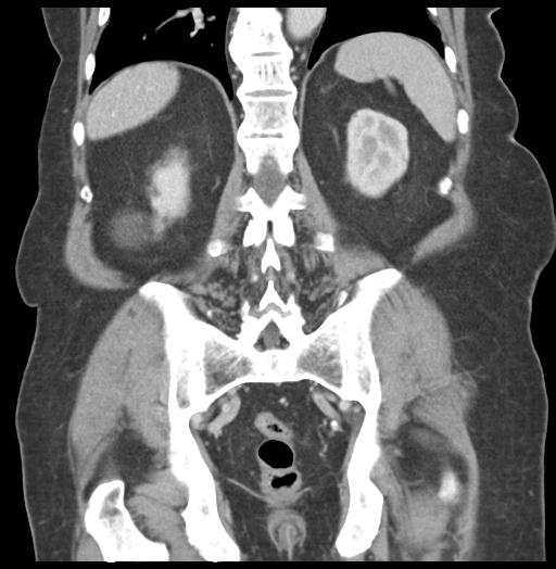 Adult ileal intussusception with secondary obstruction (Radiopaedia 30395-31051 Coronal C+ portal venous phase 46).jpg