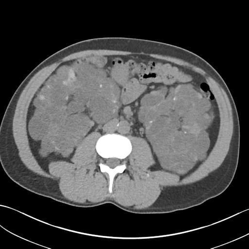 File:Adult polycystic kidney disease (Radiopaedia 47866-52626 Axial non-contrast 41).png