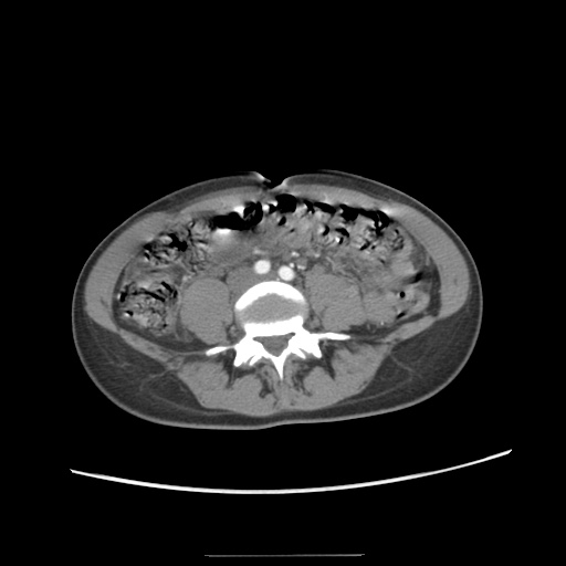 Adult polycystic kidney disease (Radiopaedia 48845-53876 Axial renal cortical phase 47).jpg