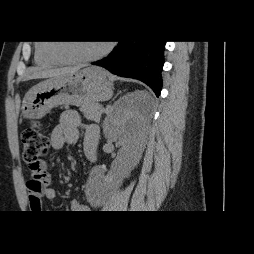 Adult polycystic kidney disease (Radiopaedia 59075-66368 Sagittal non-contrast 59).jpg