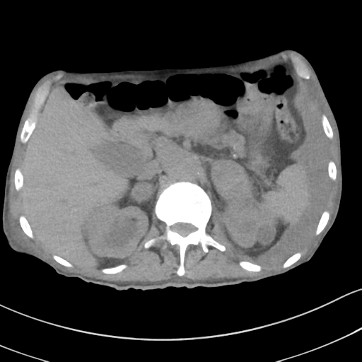 Advanced metastatic lung cancer (Radiopaedia 48910-53954 Axial non-contrast 64).png