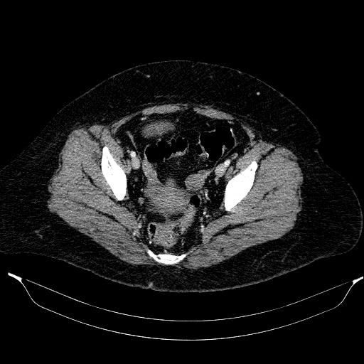 File:Afferent loop syndrome - secondary to incarcerated trocar site hernia (Radiopaedia 82959-97305 Axial C+ portal venous phase 205).jpg