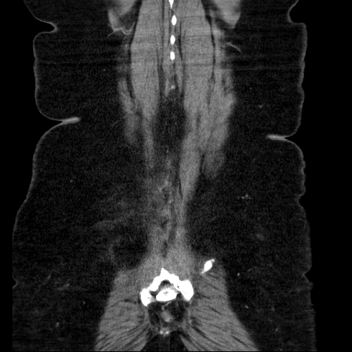 File:Afferent loop syndrome - secondary to incarcerated trocar site hernia (Radiopaedia 82959-97305 Coronal C+ portal venous phase 129).jpg