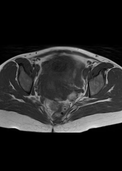 File:Aggressive angiomyxoma of the pelvis and perineum (Radiopaedia 59162-66479 T1 14).jpg