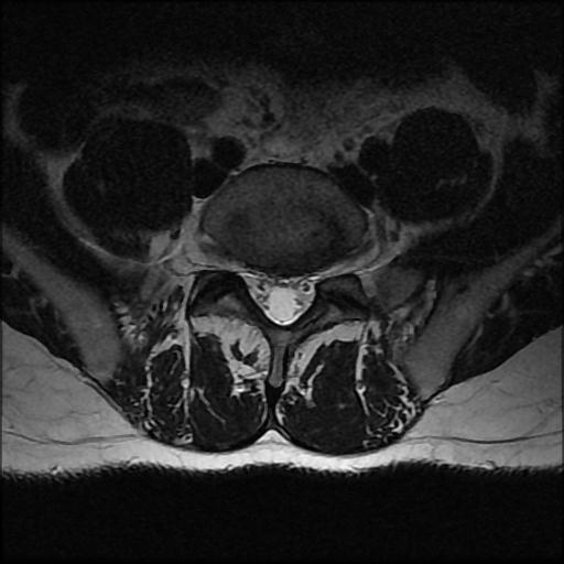 File:Aggressive vertebral hemangioma with pathological fracture (Radiopaedia 69528-79411 Axial T2 3).jpg