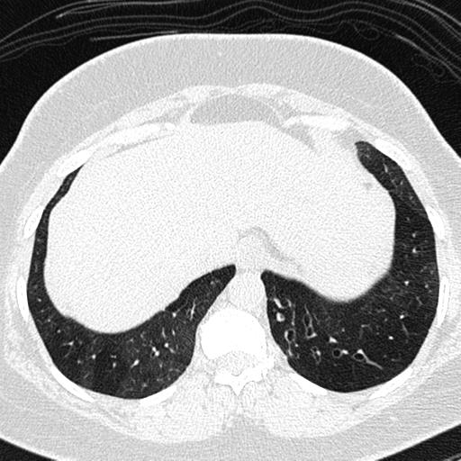 File:Air trapping in small airway disease (Radiopaedia 61685-69694 Axial lung window 163).jpg