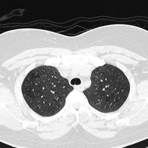 Air trapping in small airway disease (Radiopaedia 61685-69694 Axial lung window 37).jpg